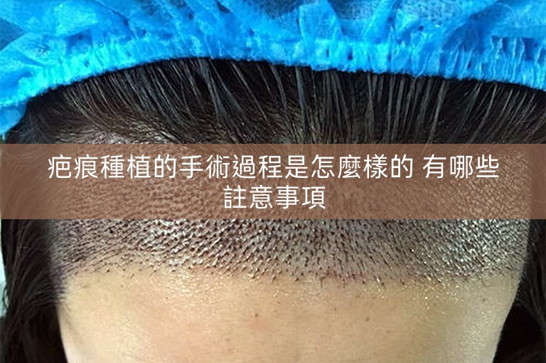 疤痕種植的手術過程是怎麼樣的 有哪些註意事項 疤痕種植的手術過程是怎麼樣的 有哪些註意事項