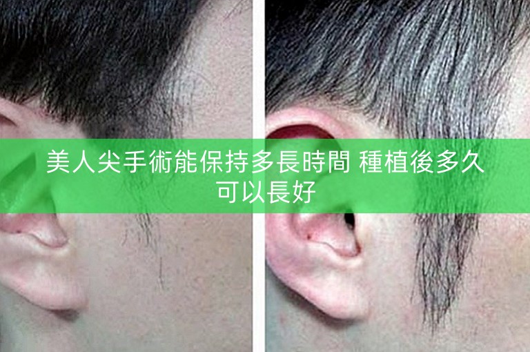 美人尖手術能保持多長時間 種植後多久可以長好