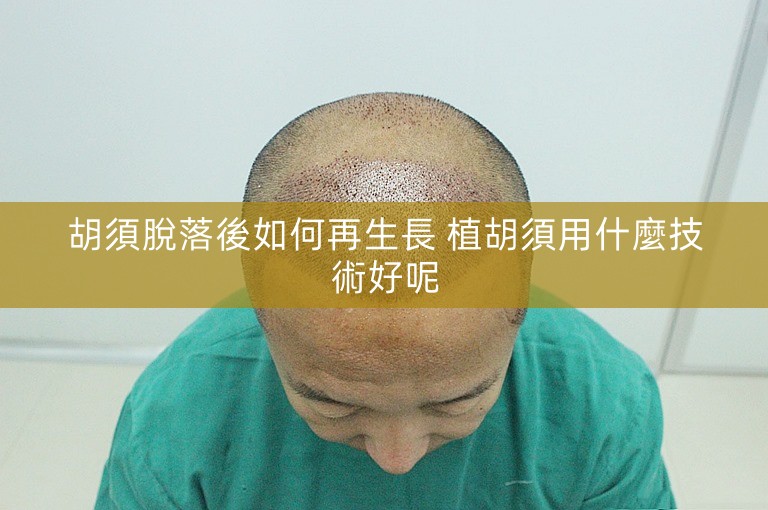 胡須脫落後如何再生長 植胡須用什麼技術好呢