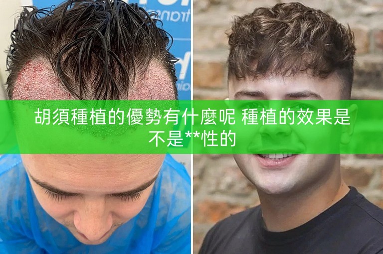 胡須種植的優勢有什麼呢 種植的效果是不是**性的 胡須種植的優勢有什麼呢 種植的效果是不是**性的