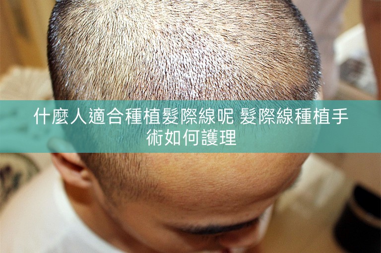 什麼人適合種植髮際線呢 髮際線種植手術如何護理