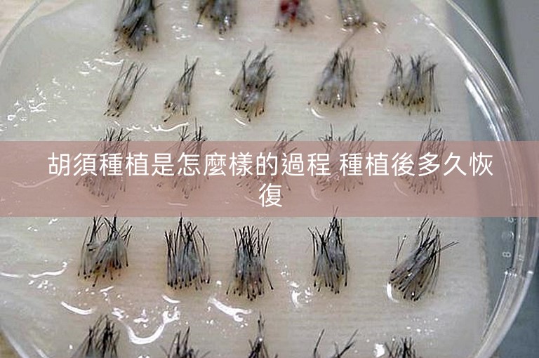 胡須種植是怎麼樣的過程 種植後多久恢復 胡須種植是怎麼樣的過程 種植後多久恢復