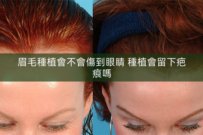 眉毛種植會不會傷到眼睛 種植會留下疤痕嗎