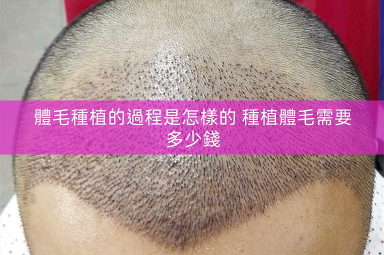 體毛種植的過程是怎樣的 種植體毛需要多少錢