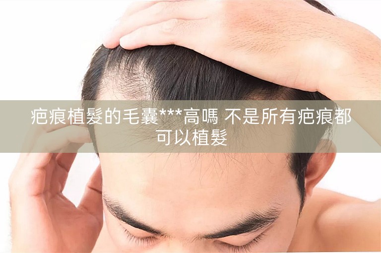 疤痕植髮的毛囊***高嗎 不是所有疤痕都可以植髮