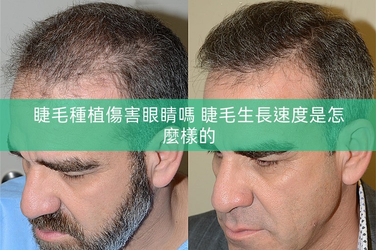 睫毛種植傷害眼睛嗎 睫毛生長速度是怎麼樣的