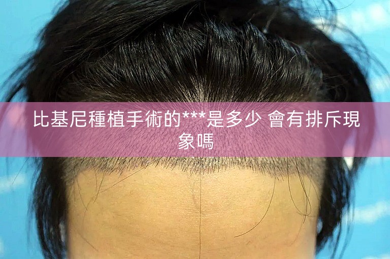 比基尼種植手術的***是多少 會有排斥現象嗎 比基尼種植手術的***是多少 會有排斥現象嗎