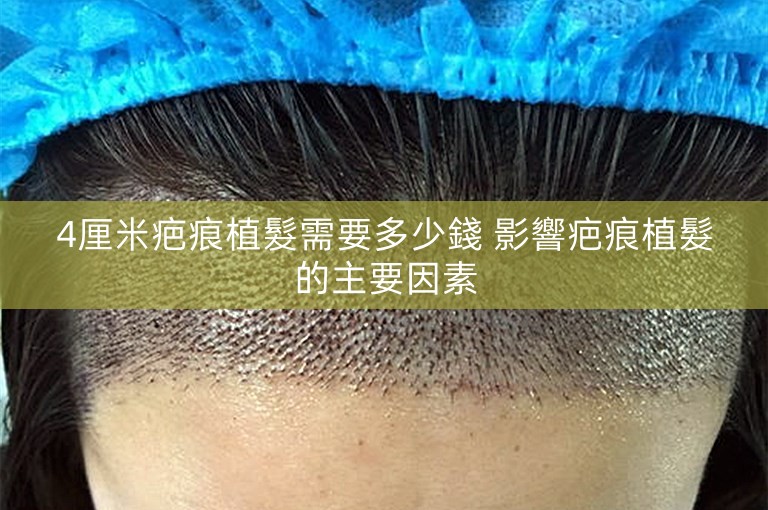 4厘米疤痕植髮需要多少錢 影響疤痕植髮的主要因素