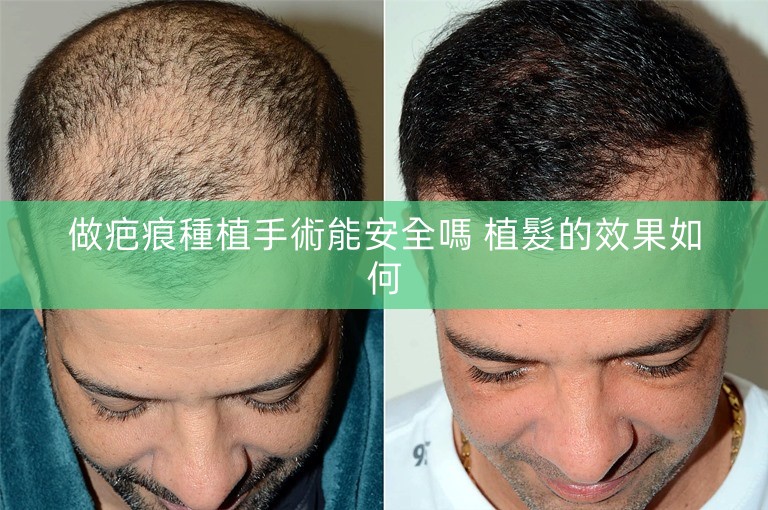做疤痕種植手術能安全嗎 植髮的效果如何