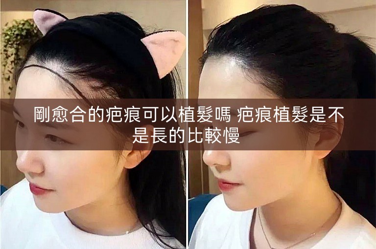 剛愈合的疤痕可以植髮嗎 疤痕植髮是不是長的比較慢 剛愈合的疤痕可以植髮嗎 疤痕植髮是不是長的比較慢