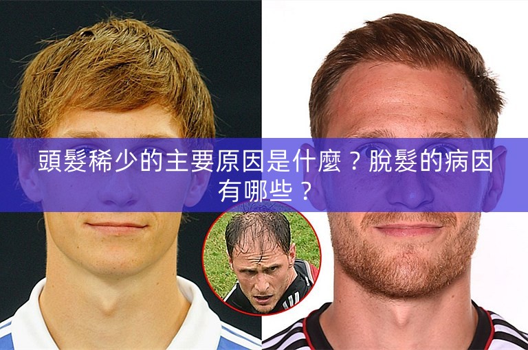 頭髮稀少的主要原因是什麼？脫髮的病因有哪些？