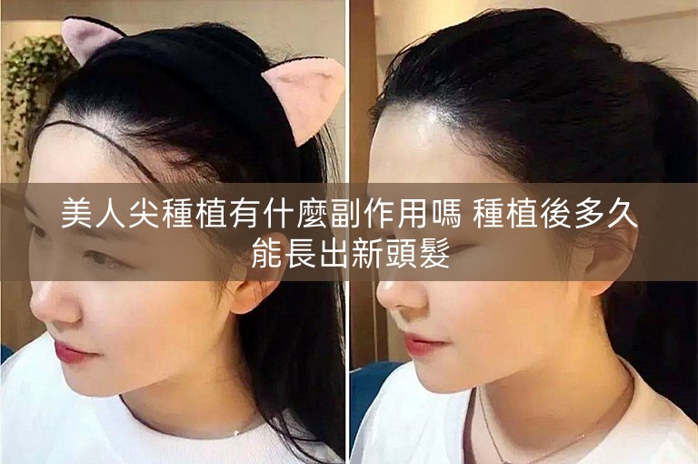 美人尖種植有什麼副作用嗎 種植後多久能長出新頭髮