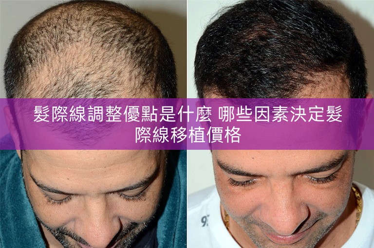髮際線調整優點是什麼 哪些因素決定髮際線移植價格