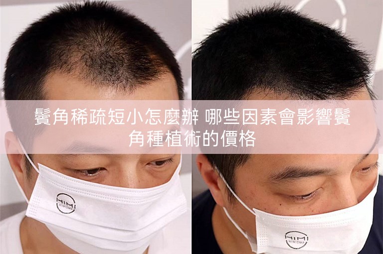 鬢角稀疏短小怎麼辦 哪些因素會影響鬢角種植術的價格