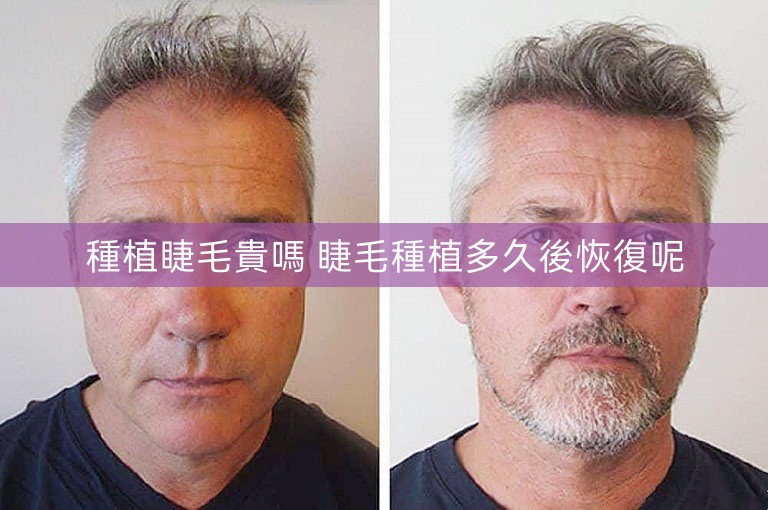 種植睫毛貴嗎 睫毛種植多久後恢復呢