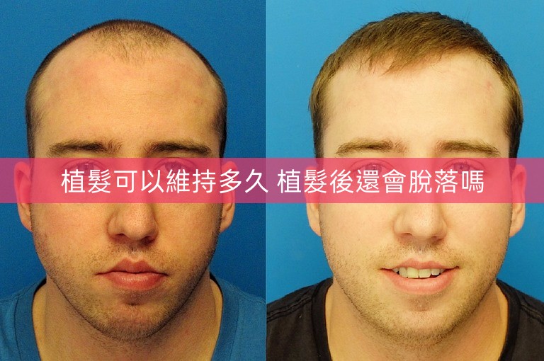 植髮可以維持多久 植髮後還會脫落嗎