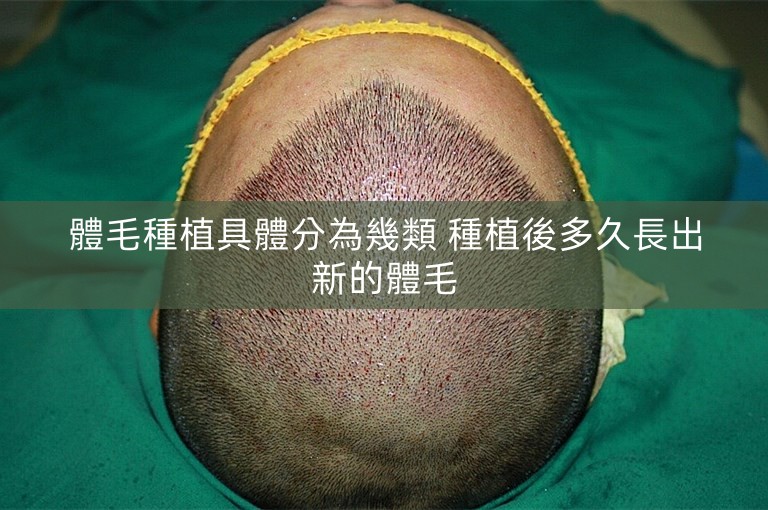 體毛種植具體分為幾類 種植後多久長出新的體毛