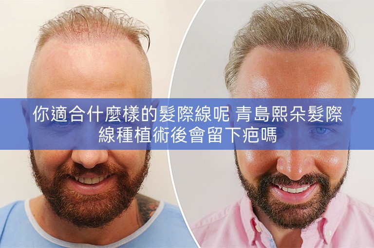 你適合什麼樣的髮際線呢 青島熙朵髮際線種植術後會留下疤嗎
