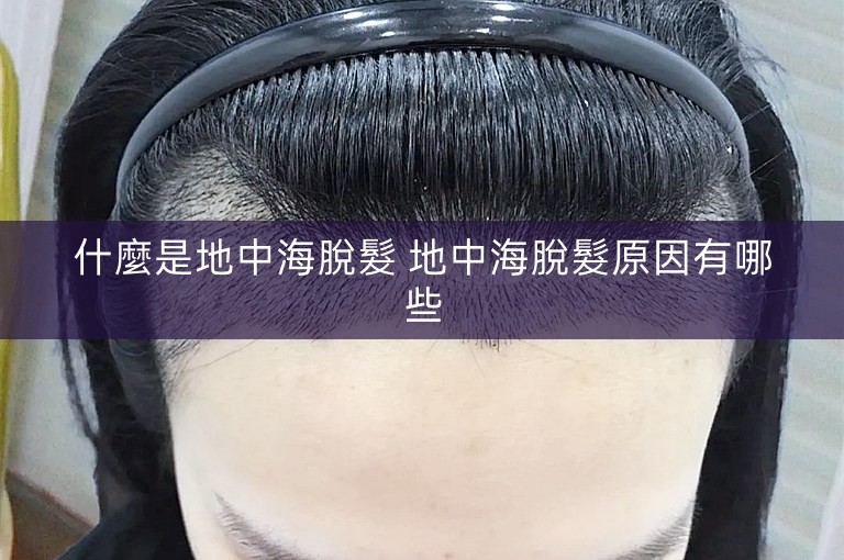什麼是地中海脫髮 地中海脫髮原因有哪些