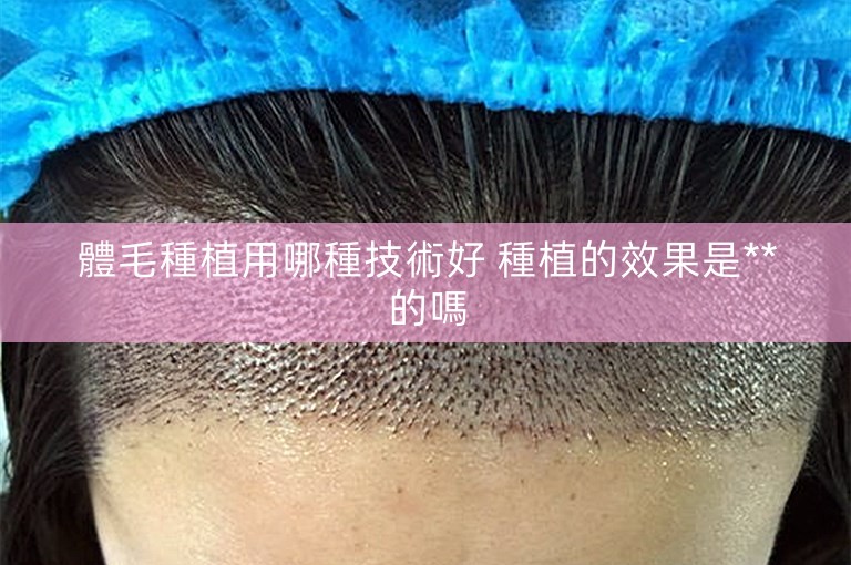 體毛種植用哪種技術好 種植的效果是**的嗎