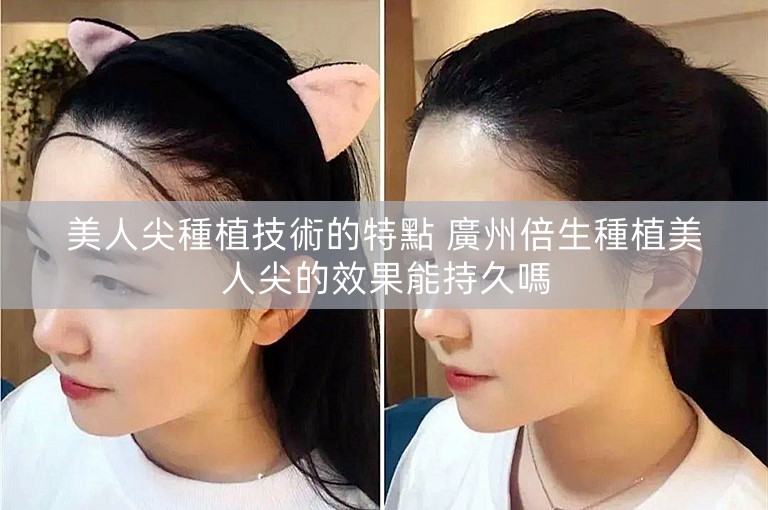 美人尖種植技術的特點 廣州倍生種植美人尖的效果能持久嗎