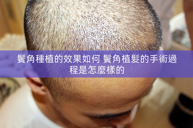 鬢角種植的效果如何 鬢角植髮的手術過程是怎麼樣的
