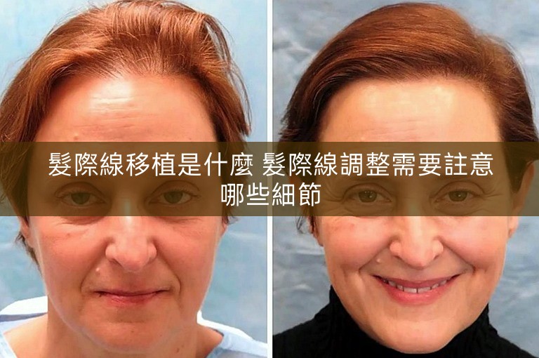 髮際線移植是什麼 髮際線調整需要註意哪些細節