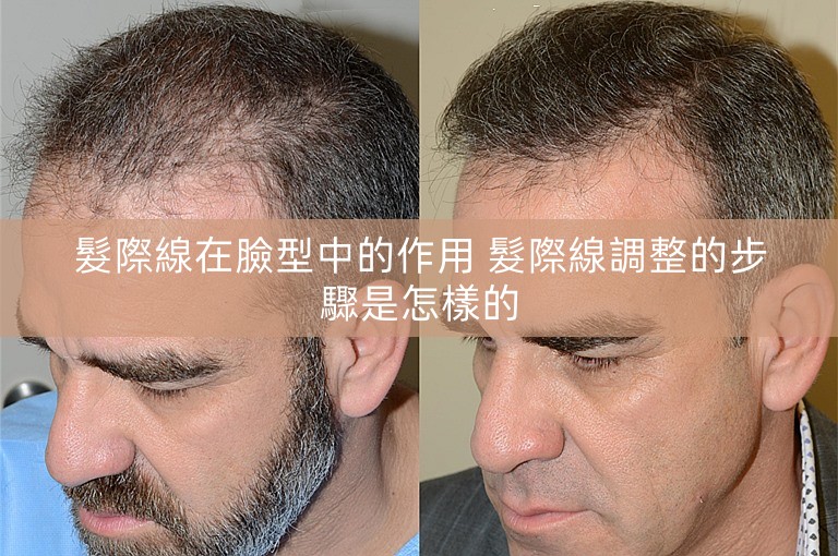 髮際線在臉型中的作用 髮際線調整的步驟是怎樣的