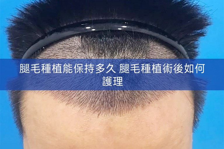 腿毛種植能保持多久 腿毛種植術後如何護理