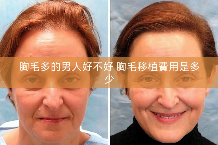 胸毛多的男人好不好 胸毛移植費用是多少