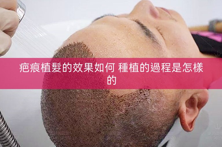 疤痕植髮的效果如何 種植的過程是怎樣的 疤痕植髮的效果如何 種植的過程是怎樣的