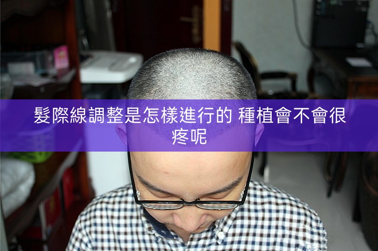 髮際線調整是怎樣進行的 種植會不會很疼呢