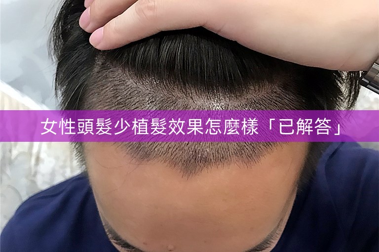 女性頭髮少植髮效果怎麼樣「已解答」