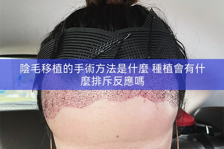 陰毛移植的手術方法是什麼 種植會有什麼排斥反應嗎 陰毛移植的手術方法是什麼 種植會有什麼排斥反應嗎