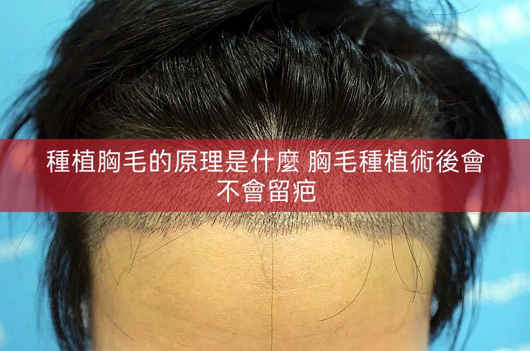 種植胸毛的原理是什麼 胸毛種植術後會不會留疤 種植胸毛的原理是什麼 胸毛種植術後會不會留疤