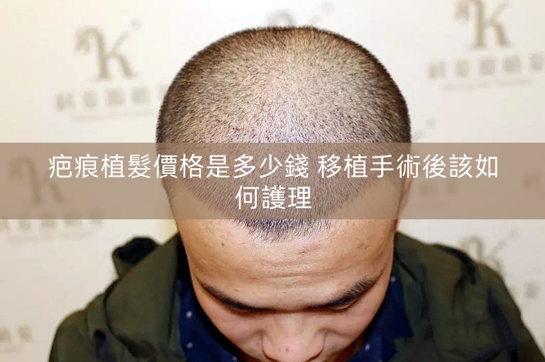 疤痕植髮價格是多少錢 移植手術後該如何護理