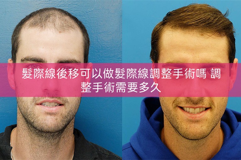 髮際線後移可以做髮際線調整手術嗎 調整手術需要多久