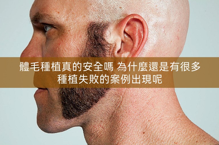 體毛種植真的安全嗎 為什麼還是有很多種植失敗的案例出現呢