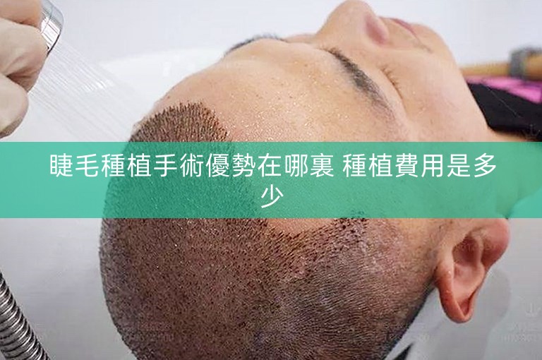 睫毛種植手術優勢在哪裏 種植費用是多少