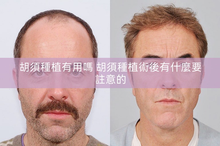 胡須種植有用嗎 胡須種植術後有什麼要註意的