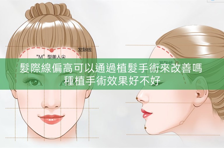 髮際線偏高可以通過植髮手術來改善嗎 種植手術效果好不好