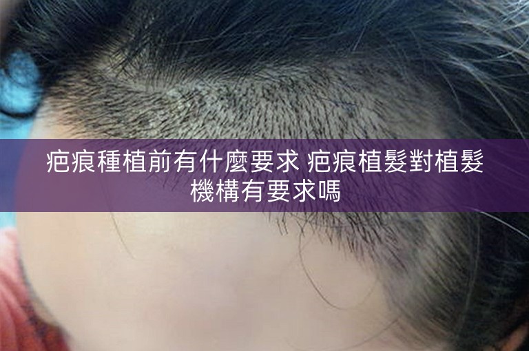 疤痕種植前有什麼要求 疤痕植髮對植髮機構有要求嗎