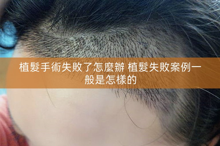 植髮手術失敗了怎麼辦 植髮失敗案例一般是怎樣的 植髮手術失敗了怎麼辦 植髮失敗案例一般是怎樣的