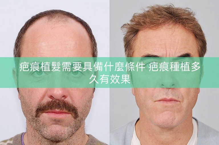 疤痕植髮需要具備什麼條件 疤痕種植多久有效果 疤痕植髮需要具備什麼條件 疤痕種植多久有效果