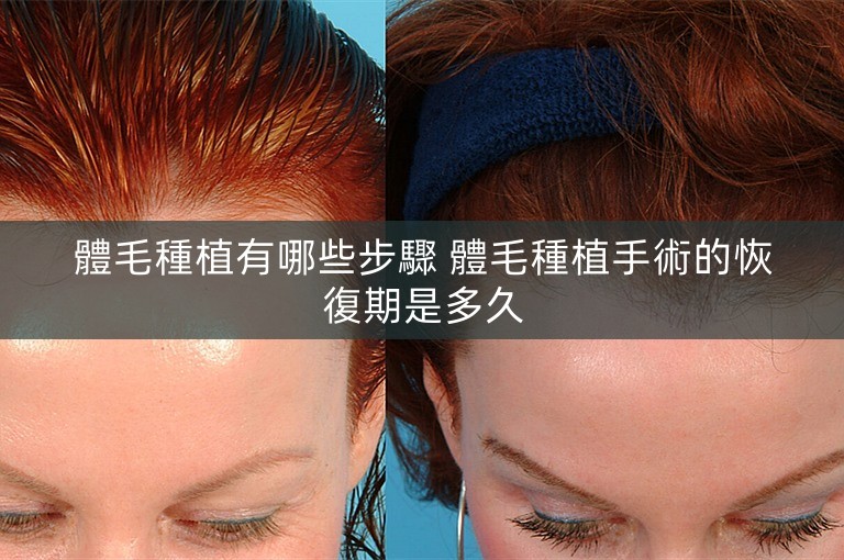 體毛種植有哪些步驟 體毛種植手術的恢復期是多久
