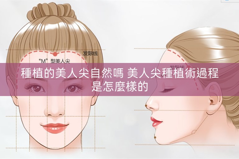 種植的美人尖自然嗎 美人尖種植術過程是怎麼樣的 種植的美人尖自然嗎 美人尖種植術過程是怎麼樣的