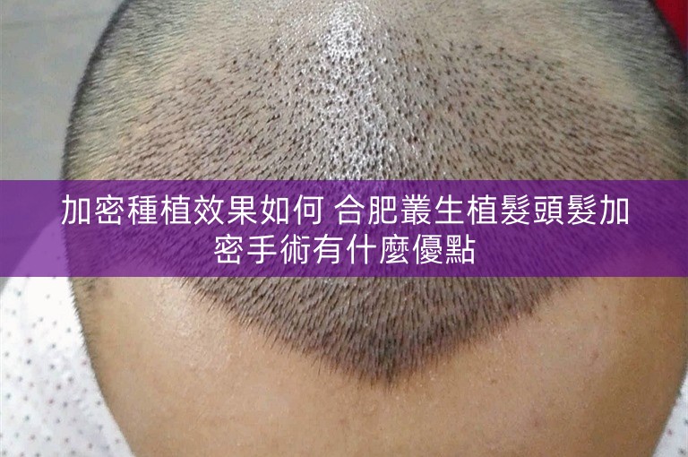 加密種植效果如何 合肥叢生植髮頭髮加密手術有什麼優點
