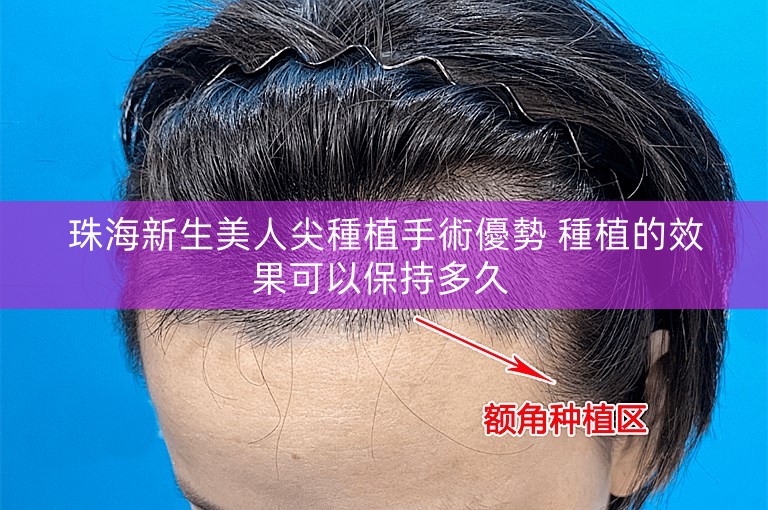 珠海新生美人尖種植手術優勢 種植的效果可以保持多久 