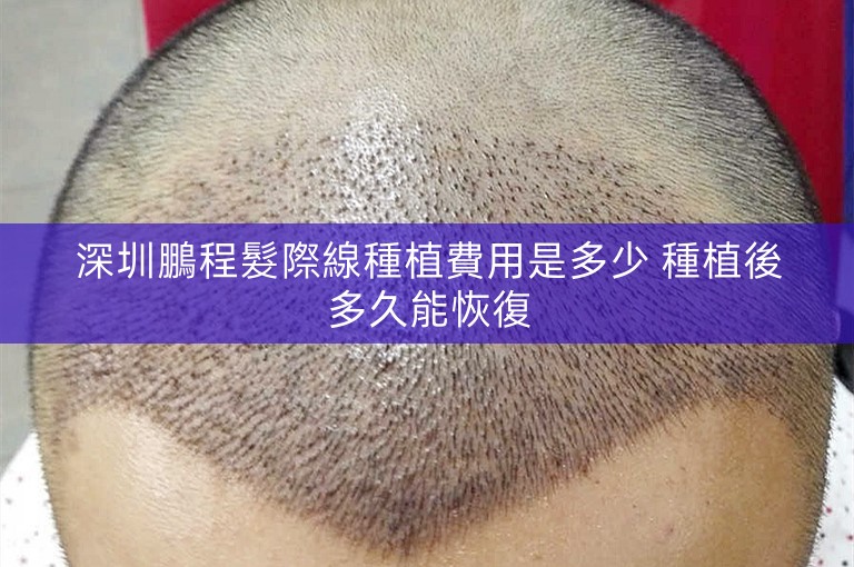 深圳鵬程髮際線種植費用是多少 種植後多久能恢復