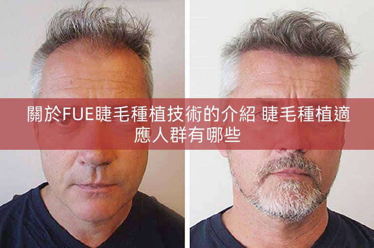 關於FUE睫毛種植技術的介紹 睫毛種植適應人群有哪些